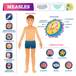 Measles Infographic